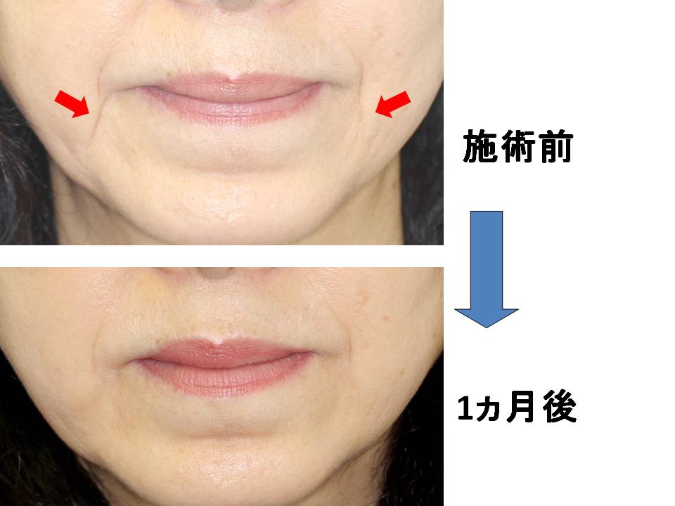 ネット ライン 改善 マリオ 口もと、口角のしわ（マリオネットライン）が気になる時の解消方法｜東京新宿の美容整形ならもとび美容外科クリニック